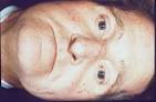 <b>Systemic</b> sclerosis -