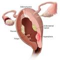 Endometrial Hyperplasia