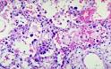 Pneumonia