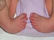 Club foot - Wikipedia, the free encyclopedia