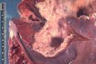 File:<b>Liver</b> containing <b>amebic</b>