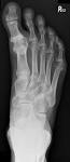 Congenital <b>hallux varus</b>, like
