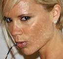 Acne Symptoms on the Face