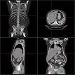 <b>Hepatomegaly</b> - Wikipedia, the free encyclopedia