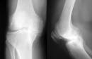 Degenerative Joint Disease