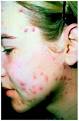 SPOTS ON YOUR FACE (ACNE)?