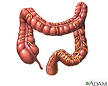 Colorectal Cancer: MedlinePlus
