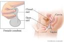 Barrier methods of birth control