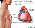 Cardiac tamponade - Scripps Health - San Diego