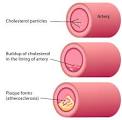 http://www.abc.net.au/health/library/img/cholesterol_arteries.jpg