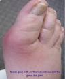 Gout Symptoms - Home
