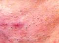 Acne Solutions - How to get rid of blackheads fast