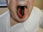 Tongue <b>Hematoma</b>: The result of