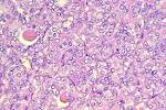 <b>papillary carcinoma</b> of the