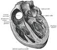 Ischaemic heart disease