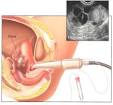 In Vitro Fertilization IVF Long Island New York Infertility Center