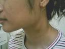 <b>Tuberculosis Ganglionar</b>: A