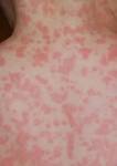 File:Amoxicillin rash 11 hours after 17th dose.JPG - Wikipedia ...