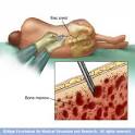 In a <b>bone marrow</b> aspiration