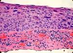 Squamous <b>Carcinoma</b> in <b>Situ</b>