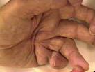 <b>Dupuytren's Contracture</b>