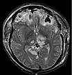 Acquired brain injury - Wikipedia, the free encyclopedia