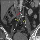 <b>Leriche Syndrome</b>.