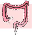 Colonscopy - definition of Colonscopy in the Medical dictionary ...