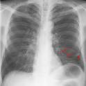 lobe <b>atelectasis</b> followed