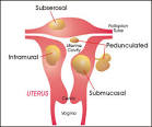 Uterine Fibroids (<b>Myoma</b>‚ Leiomyoma‚ Leiomyomata) Large & Small