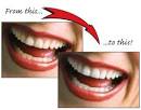 teeth whitening procedures