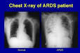 <b>sindrome da distress</b>