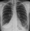 Another cause of <b>atelectasis</b>