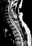 <b>Brown Sequard Syndrome</b> Images