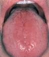 <b>Glossitis</b>.