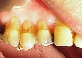 abrasion