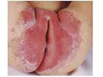 Bacterial <b>diaper</b> dermatitis: