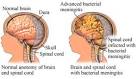 Fungal <b>meningitis</b> outbreak