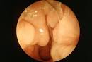 Slideshow  Sinusitis Symptoms and Treatments