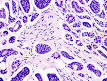 <b>adenoid cystic carcinoma</b>