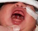 Cleft <b>Palate</b>