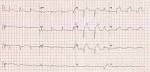 There are <b>premature atrial</b>