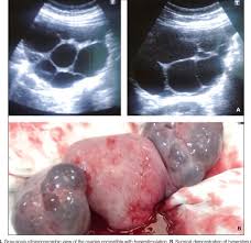 Image result for hydatidiform mole of ovary