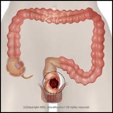 colorectal cancer