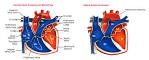Patent <b>Ductus Arteriosus</b>