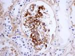 <b>nephritis</b> IgA