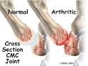 A Patient's Guide to Resection (Excision) Arthroplasty of the Thumb