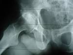Degenerative Joint Disease