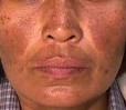 Melasma is a skin condition