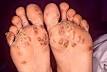 Reactive arthritis - Wikipedia, the free encyclopedia